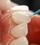 a tooth with a blue toothbrush in it